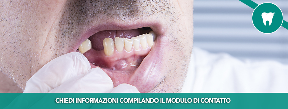 Mobilità Dentale, uno dei primi sintomi della parodontite