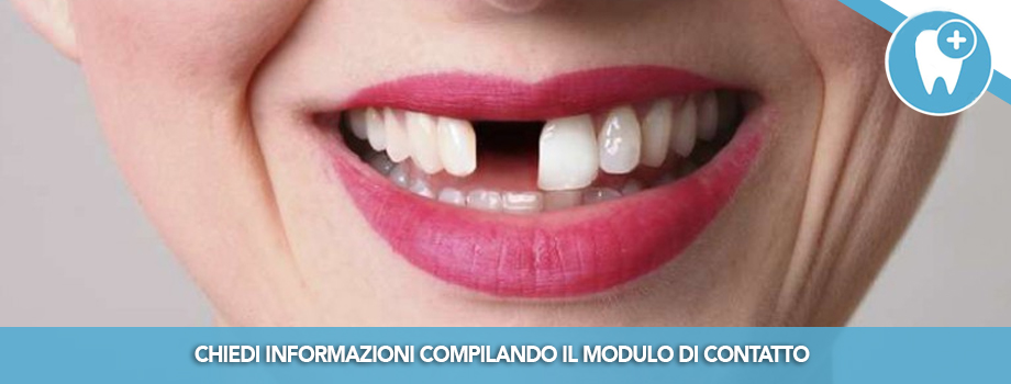 I denti sono davvero persi con la parodontite?
